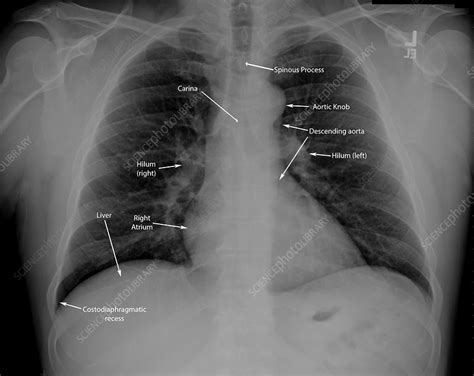 Normal Chest X Ray With Labels