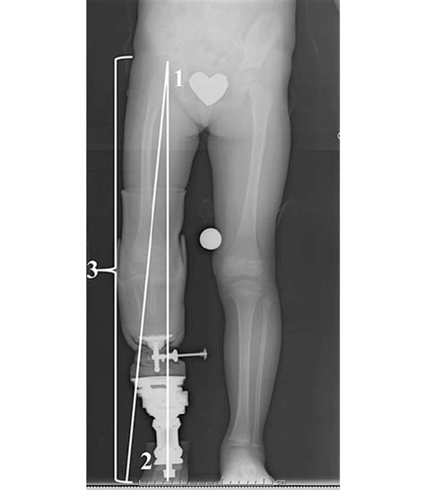 Radiographic Measurements Mechanical Axis Angular Deviation