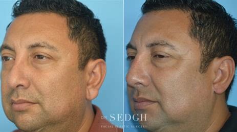 Ear Lobe Reduction Before and After Photos | Dr. Sedgh