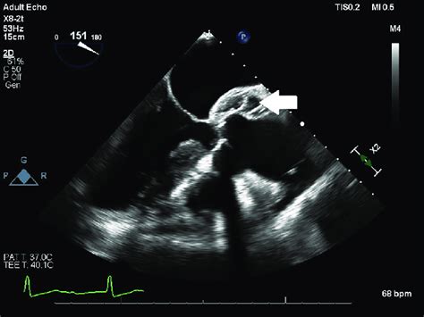 Periaortic hematoma located at the aortic root. The hematoma was noted ...