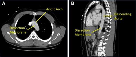 A Computed Tomography Ct Demonstrated The Aortic Dissection And The