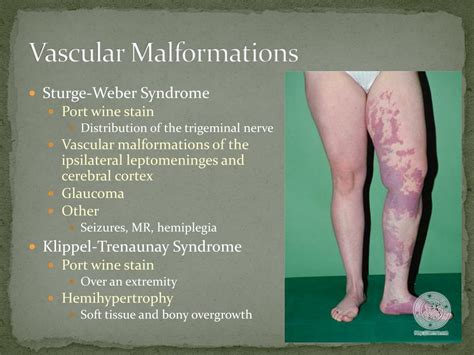 Venous Vascular Malformation