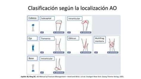 Clasificación diagnostico manejo quirúrgico fractura metacarpos PPT