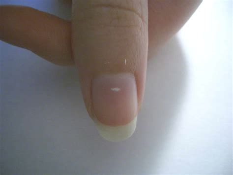 The Truth Behind The White Spots On Nails