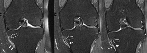 MR Imaging Findings Of Medial Tibial Crest Friction European Journal