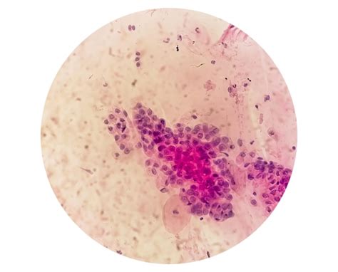 Premium Photo Trichomonas Vaginalis In Pap Smear With Few Acute Inflammatory Cells