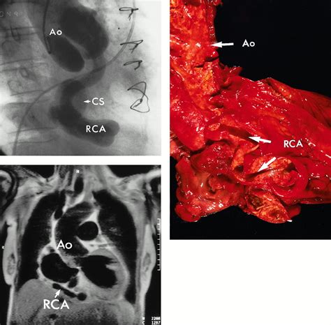 Ectasia And Aneurysm Of The Right Coronary Artery Resulting From A