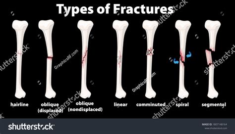 Type Of Fractures Diagram Illustration Royalty Free Stock Vector 1807148164