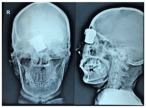 Plain X Ray Of Skull Antero Posterior And Lateral Views Showing The