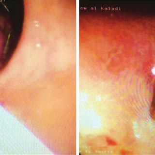 | Pedunculated polyp measuring 2 × 2.5 cm 2 found within the rectum ...