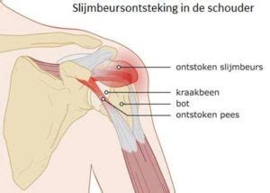 Slijmbeursontsteking Schouder Nummer 1 Oorzaak Behandeling Weten