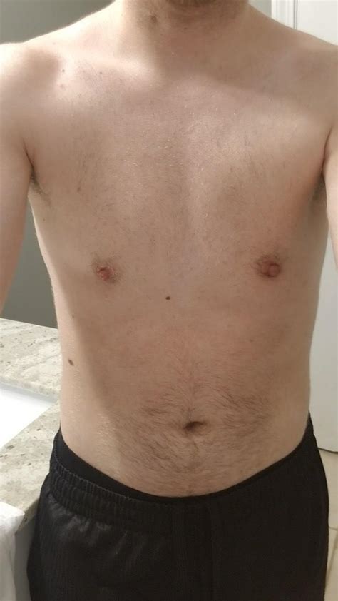 2 Years Post Op With Dr Kenneth Wolf Scrolller