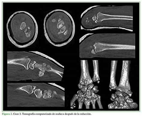 Vista De Luxofracturas Radiocarpianas Evaluaci N Retrospectiva De Una