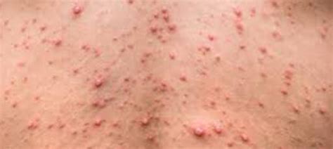 Complete Guide To Hot Tub Folliculitis Causes Symptoms Off