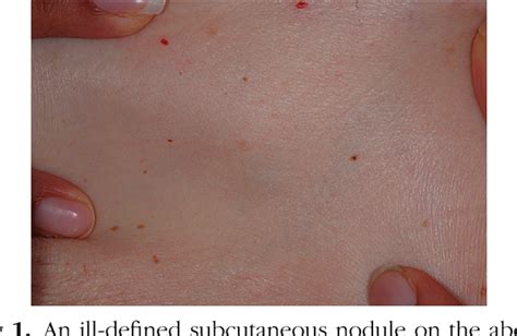 Nodular Scleroderma Presenting As Multiple Spontaneous Keloidal Scars