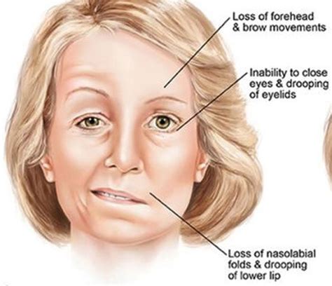 Facial Palsy – St Mark Rehab | Physical Therapy Outpatient Clinic