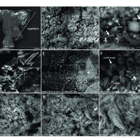 | Scanning electron microscopy of Tropheryma whipplei vegetation. (A ...