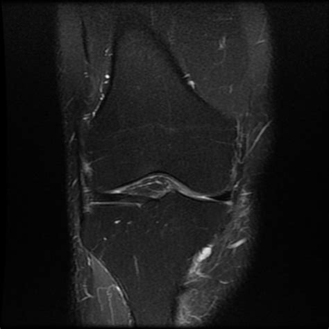 Lobulated Ganglion Cyst Knee Image