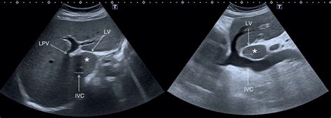 Normal Liver Anatomy Radiology Key