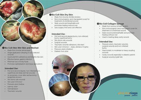 Collagen Dressing for wound healing & closure – We Care * We Heal