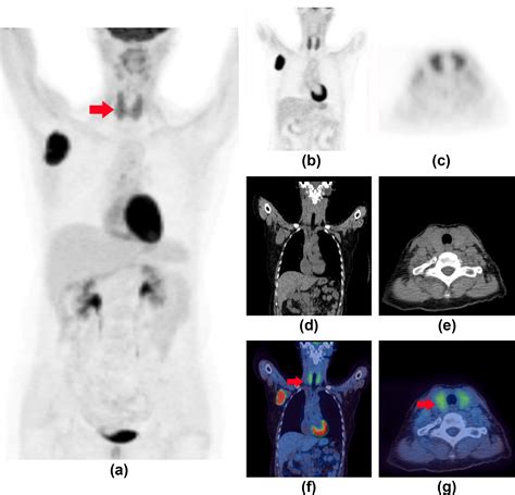 Clinical Significance Of Patterns Of Incidental Thyroid Uptake At 18f