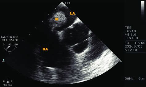 Mid Esophageal Aortic Valve Short Axis View Showing Tumor M Attached