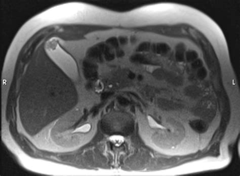 Radiopaedia case Gallbladder polyp id: 39198 study: 41431 - NC Commons