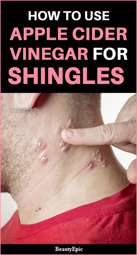 Does Apple Cider Vinegar Cure Shingles Apple Cider Vinegar Cures Apple Cider Vinegar Cider