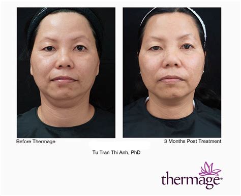 Thermage Skin Tightening Laser Spa Group