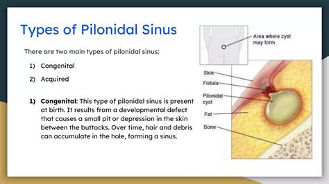 What Is Pilonidal Sinus Causes Symptoms And Treatment Pptx