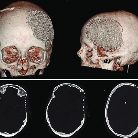 Postoperative 3D Computed Tomography Reconstruction Of A Patient