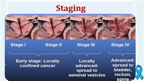 Prostate Cancer Ppt