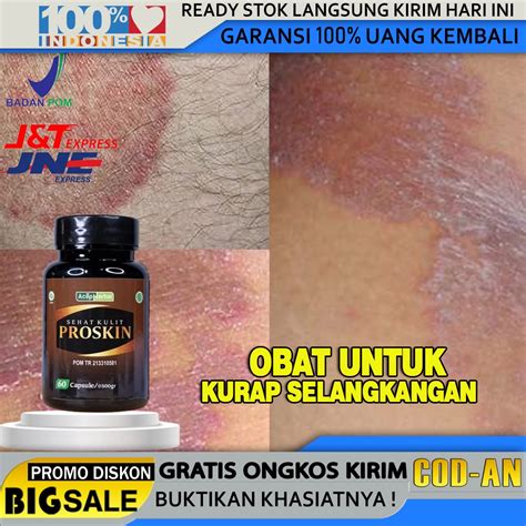 Jual Obat Penghilang Kurap Di Selangkangan Di Kepala Di Wajah Di