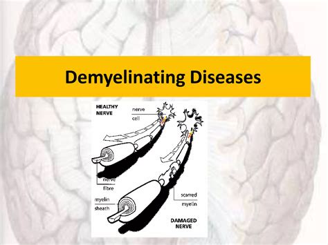 Disorders Of Corpus Callosum Ppt