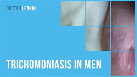 ↪ Trichomoniasis In Men Youtube