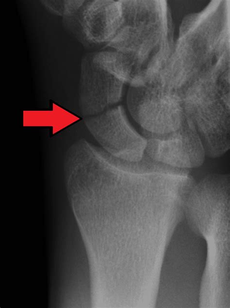 X Rayofscaphoidfracture Rebel Em Emergency Medicine Blog