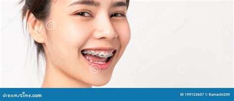 Face Of A Young Smiling Asian Woman With Braces On Teeth Orthodontic Treatment Stock Image