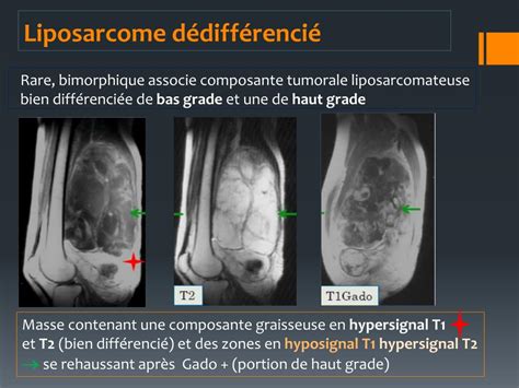 PPT IMAGERIE DES TUMEURS GRAISSEUSES PowerPoint Presentation Free