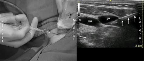 Scielo Brasil Ultrasound Guided Central Venous Catheterization