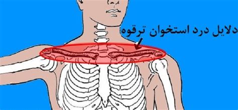 شکستگی ترقوه Clavicle fracture چیست4 روش درمان آن