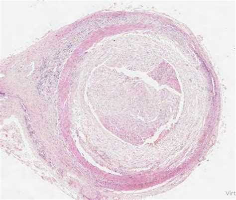 Tunica media - GCA Histology