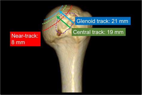 glenoid track  subcritical hill sachs lesion jses international