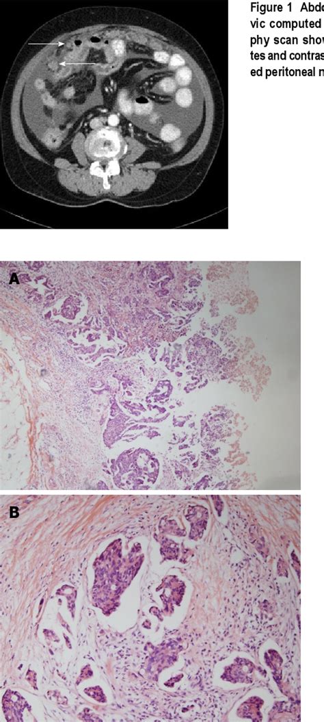 Figure 1 From Tertiary Syphilis Mimicking Hepatic Metastases Of