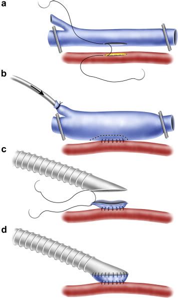 A Novel Method Of Vein Cuff Creation For Below Knee Femoropopliteal Bypass With A Prosthetic