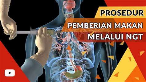 Prosedur Keperawatan Pemberian Makan Melalui Nasogastric Tube Ngt