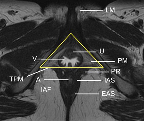 Imaging Of The Female Perineum In Adults Radiographics