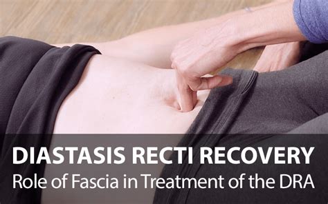 Diastasis Recti: Symptoms, Causes Treatment, 59% OFF