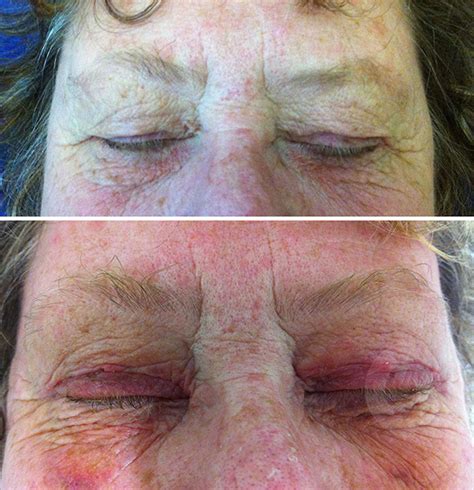 Upper Eyelid Skin Excess And Scars Days After Operation Dr Sonja