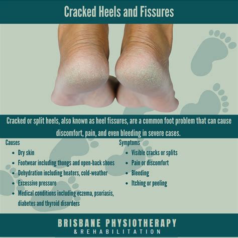 cracked heels  fissures brisbane physiotherapy podiatry