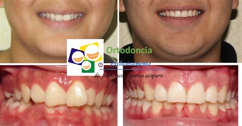 Corrección de mordidas profundas OrtoAispuro Dental